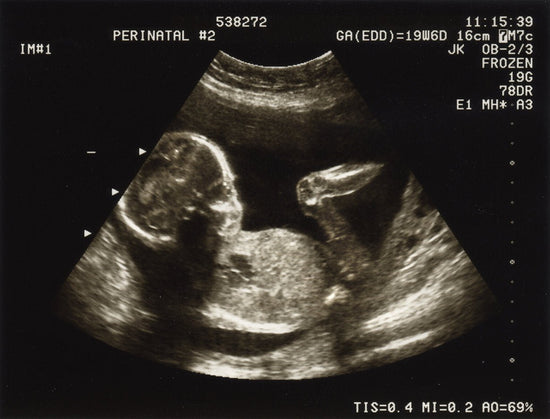 What’s the Truth Behind all the Posts About Ozempic Babies? We Ask an Expert. - needed.
