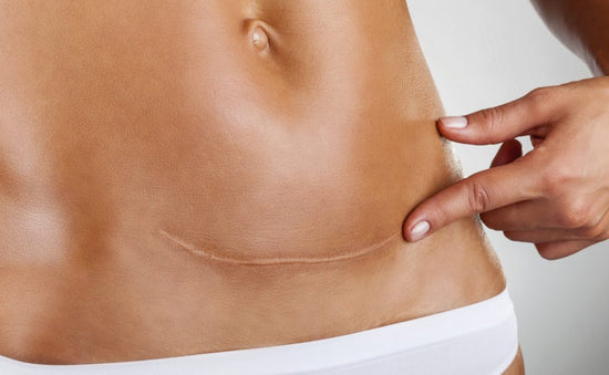 No, a C-Section Isn’t the “Easy Way Out” - But Here’s How to Make Recovery Easier - needed.